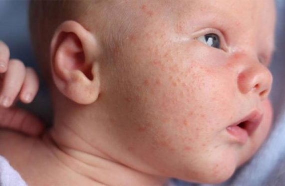 Các dấu hiệu bất thường trên da của trẻ sơ sinh