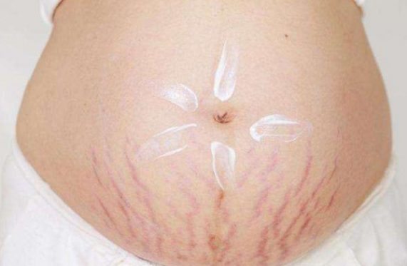 Rạn da khi mang thai