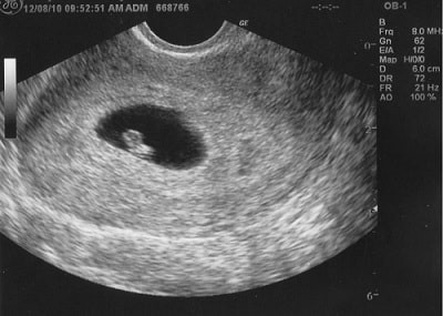Những điều xung quanh việc tiêm uốn ván trong khi mang thai lần 2, lần 3